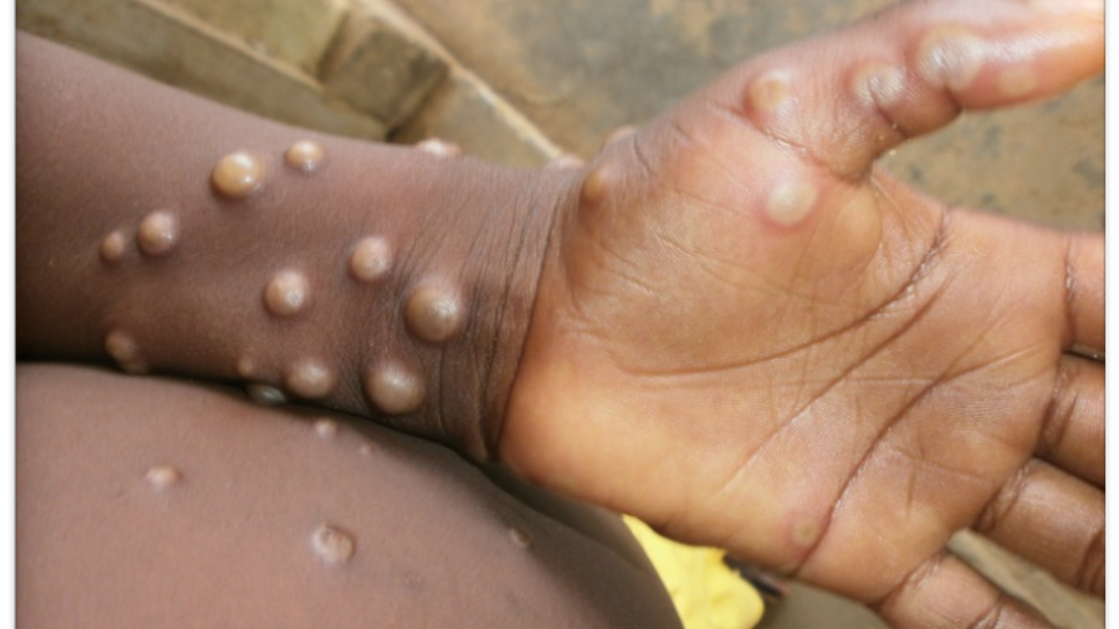 Monkeypox virus